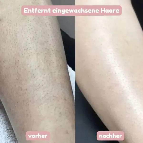 Comparaison avant et après sur une jambe : poils et irritations visibles à gauche, peau lisse et uniforme à droite après le rasage. 9