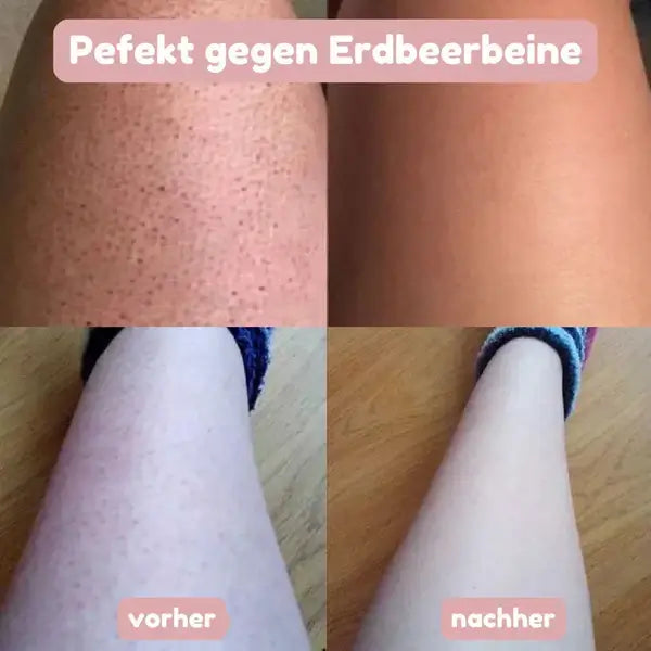 Comparaison avant et après sur des jambes : peau parsemée de petits points avant, puis peau nettement plus uniforme et lisse après utilisation. 7