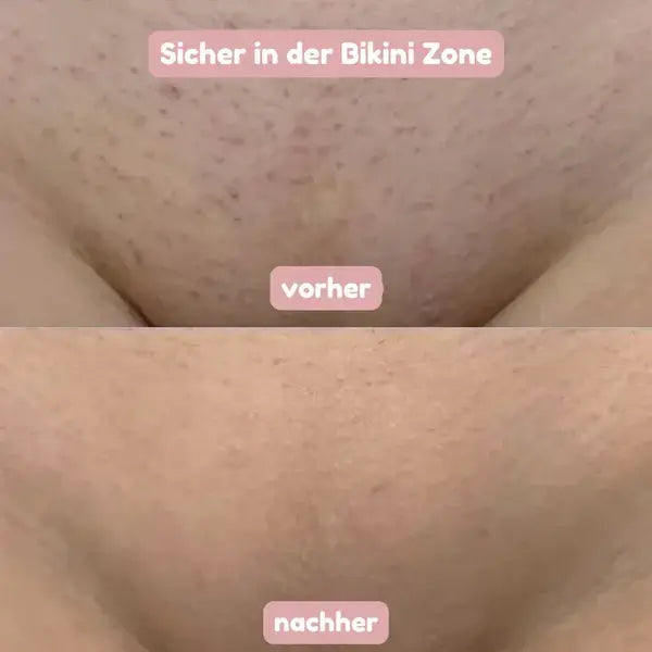 Comparaison avant et après sur la zone du maillot : peau avec poils et petits points avant, puis peau visiblement plus nette et lisse. 8