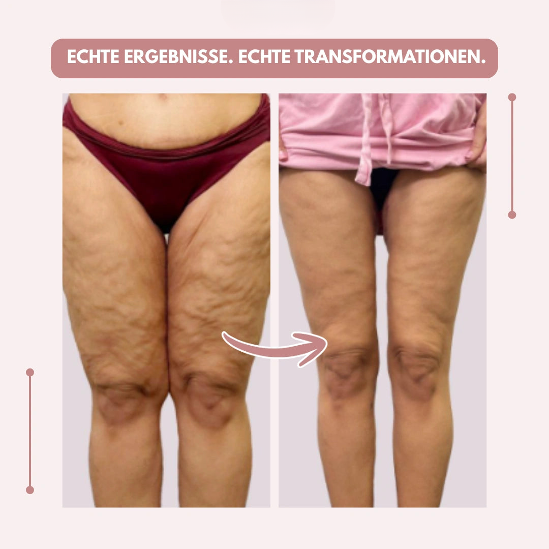 Visuel avant-après de cuisses vues de face, la peau paraissant plus lisse sur la photo de droite, sur fond rose pâle. 12
