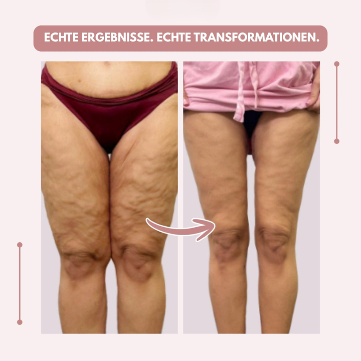 Visuel avant-après de cuisses vues de face, la peau paraissant plus lisse sur la photo de droite, sur fond rose pâle. 12
