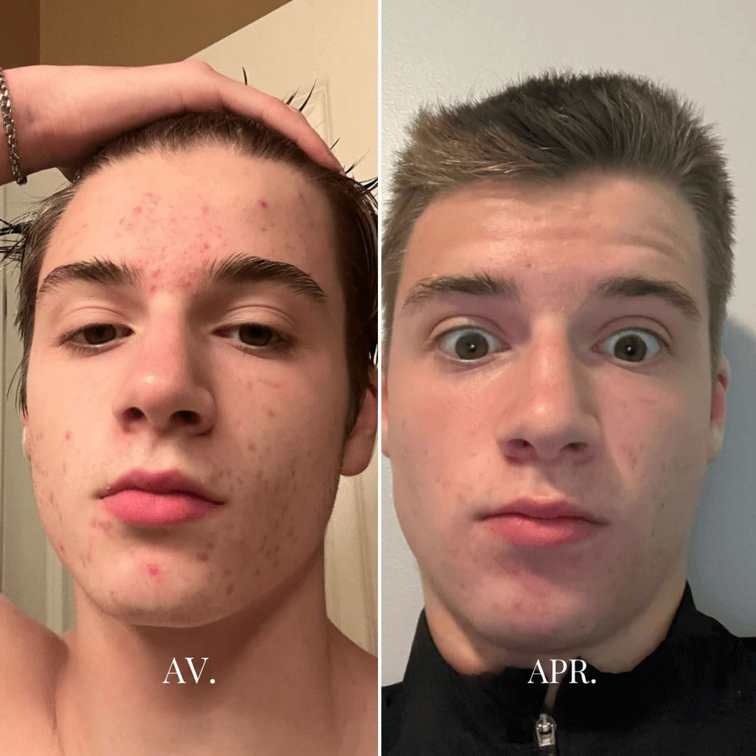 Comparaison avant et après du visage d'un jeune homme, peau avec boutons puis plus nette 3