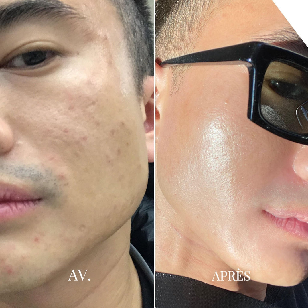 Comparaison avant et après sur la joue d'un homme, grain de peau plus lisse ensuite 7