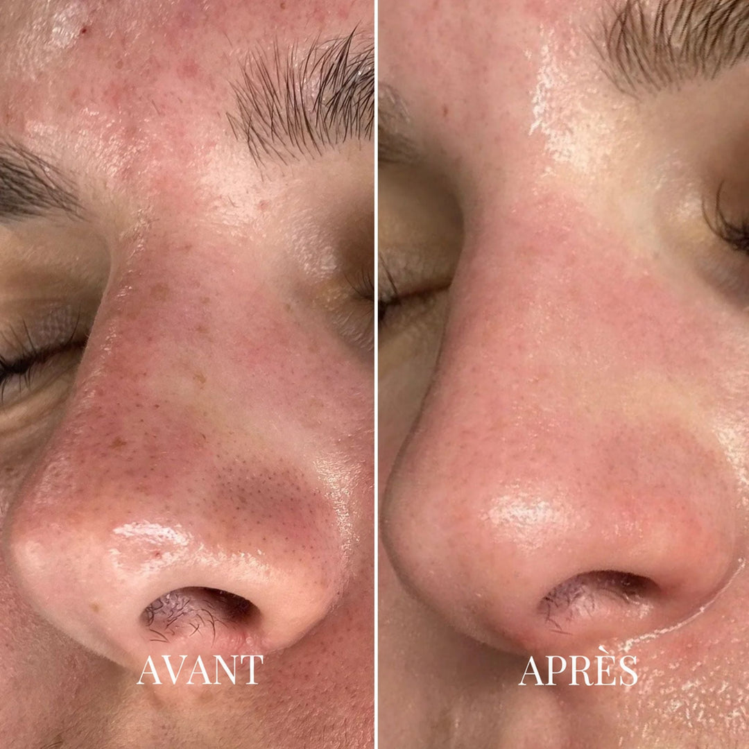 Comparaison avant et après sur un nez en gros plan, pores moins visibles 2