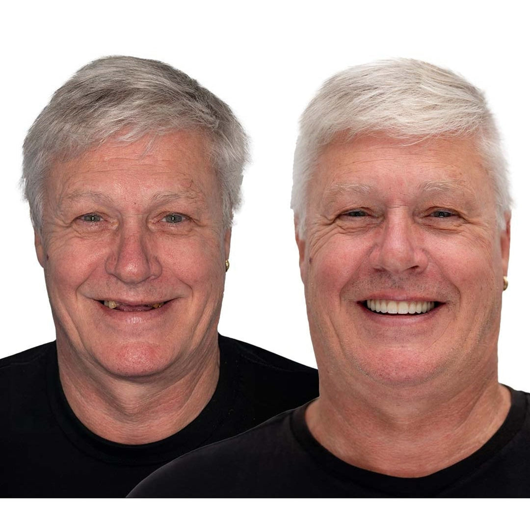 Comparaison avant-après d'un homme aux cheveux gris: sourire aux dents manquantes à gauche, sourire régulier et complet avec la prothèse à droite. 5