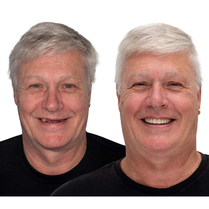Comparaison avant-après d'un homme aux cheveux gris: sourire aux dents manquantes à gauche, sourire régulier et complet avec la prothèse à droite. 5