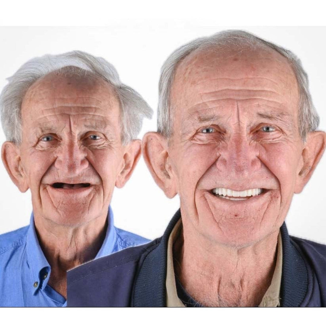 Comparaison avant-après d'un homme âgé: bouche édentée à gauche, large sourire aux dents blanches et alignées avec la prothèse à droite. 6